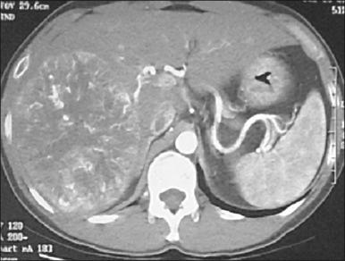 Figure 77.4, Dynamic computed tomography scan of a hypervascular right lobe hepatocellular cancer.