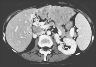 Figure 77.5, Large left lobe hepatocellular carcinoma with vascular invasion into the portal vein, demonstrated by the classic finding of tumor thrombus filling and expanding the main portal vein (arrows), with cavernous transformation of the portal vein.