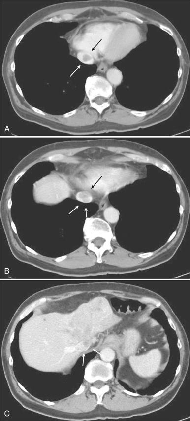 E-Figure 77.1, (A–C) Left lobe hepatocellular cancer with tumor invasion into the inferior vena cava (arrows).