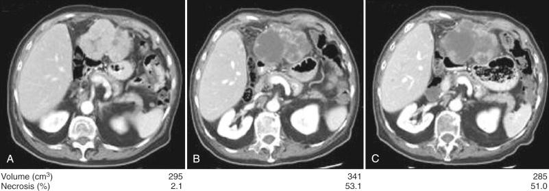 Figure 77.6, A representative example of baseline and serial follow-up scans demonstrating tumor necrosis in a patient with hepatocellular carcinoma.