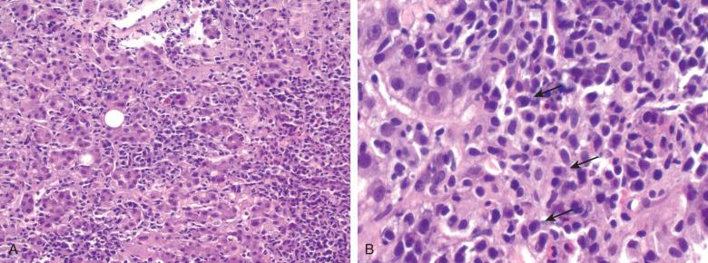 Figure 11.1, Liver biopsy in hepatitis A.