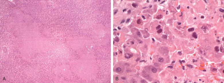 Figure 11.11, Adenovirus hepatitis.