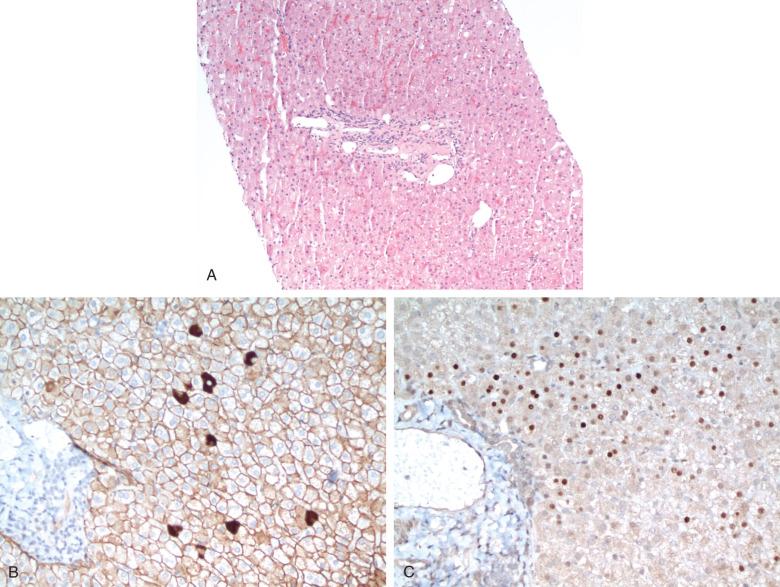 Figure 11.2, Liver biopsy in the immune tolerance phase of hepatitis B.