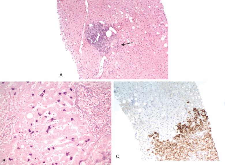 Figure 11.3, Liver biopsy in the immune clearance phase of hepatitis B.