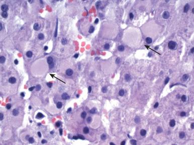 Figure 11.4, Ground-glass hepatocytes in chronic hepatitis B (arrows) . Ground-glass hepatocytes show finely granular cytoplasmic inclusions that displace the nucleus to the edge of the cell and are surrounded by a clear halo.