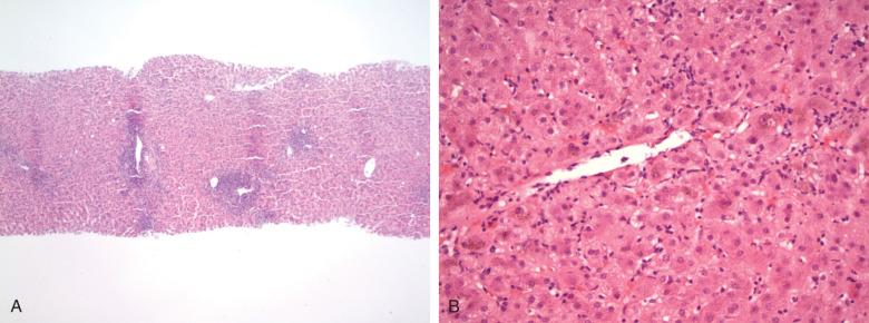 Figure 11.5, Liver biopsy in acute hepatitis C.