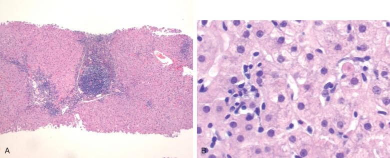 Figure 11.6, Liver biopsy in chronic hepatitis C.