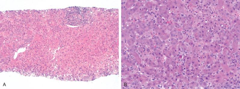 Figure 11.7, Liver biopsy in acute hepatitis E.