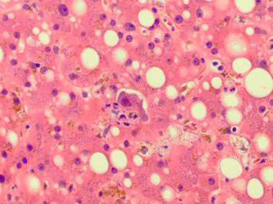 Figure 11.9, Cytomegalovirus (CMV) hepatitis, demonstrating a CMV inclusion in a hepatocyte associated with a few mononuclear inflammatory cells.