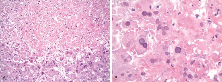 Figure 11.10, Herpes simplex virus infection.