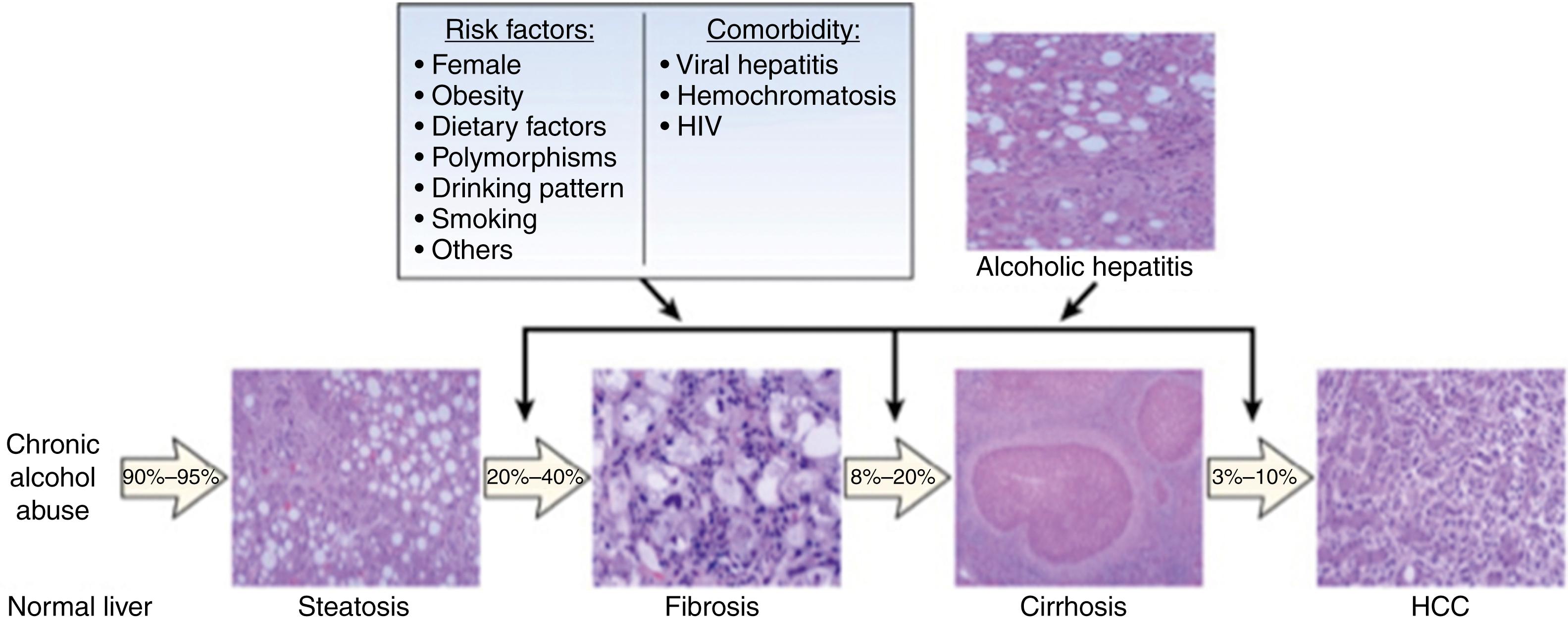 Fig. 76.11, Progression of alcoholic-related liver disease. HCC, Hepatocellular carcinoma.