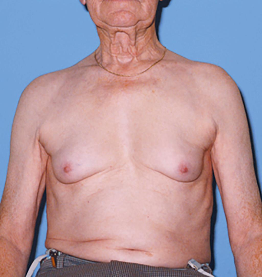 Fig. 76.12, Gynecomastia in a male patient with cirrhosis.