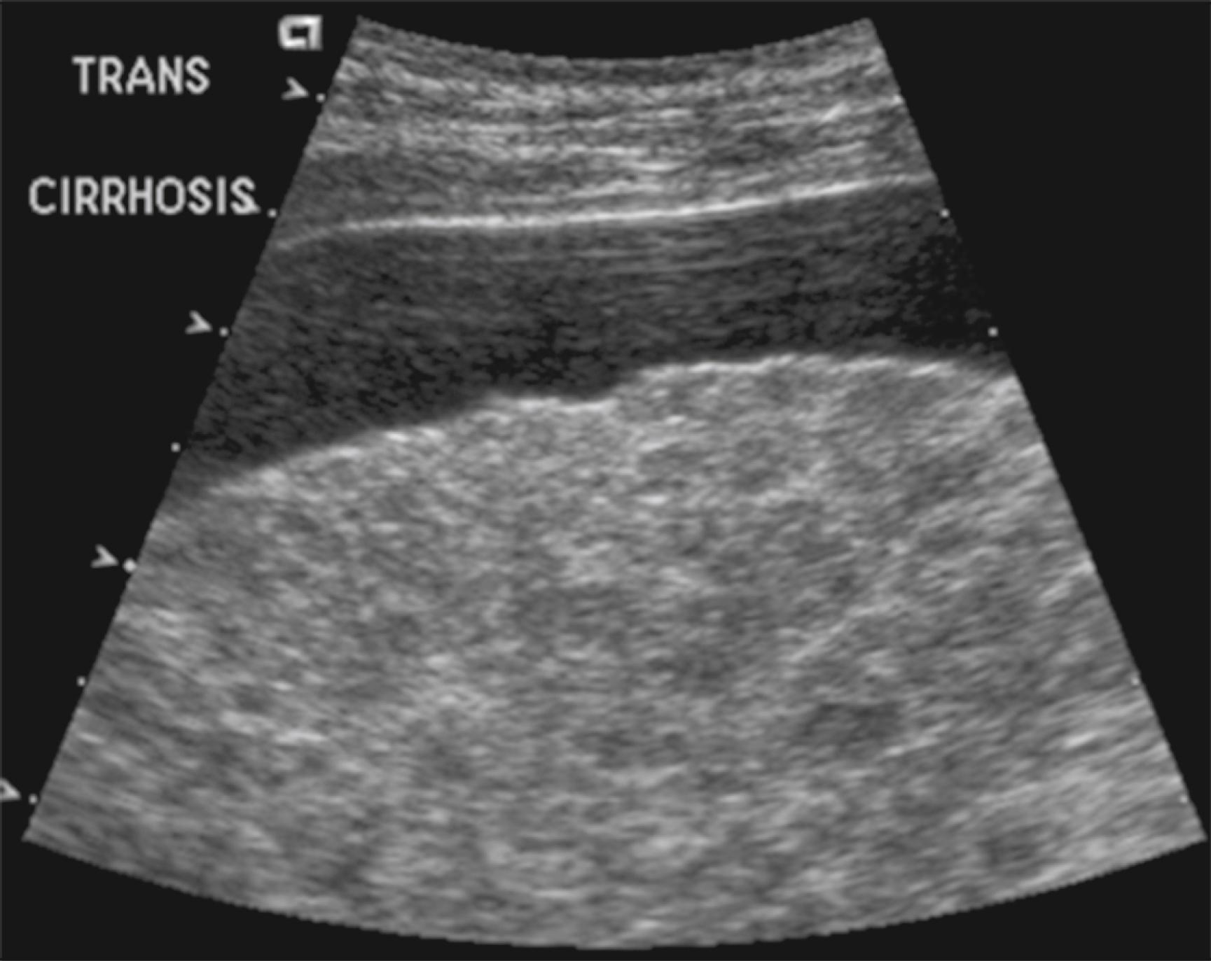 Fig. 76.15, Ultrasound of liver the demonstrating cirrhosis.