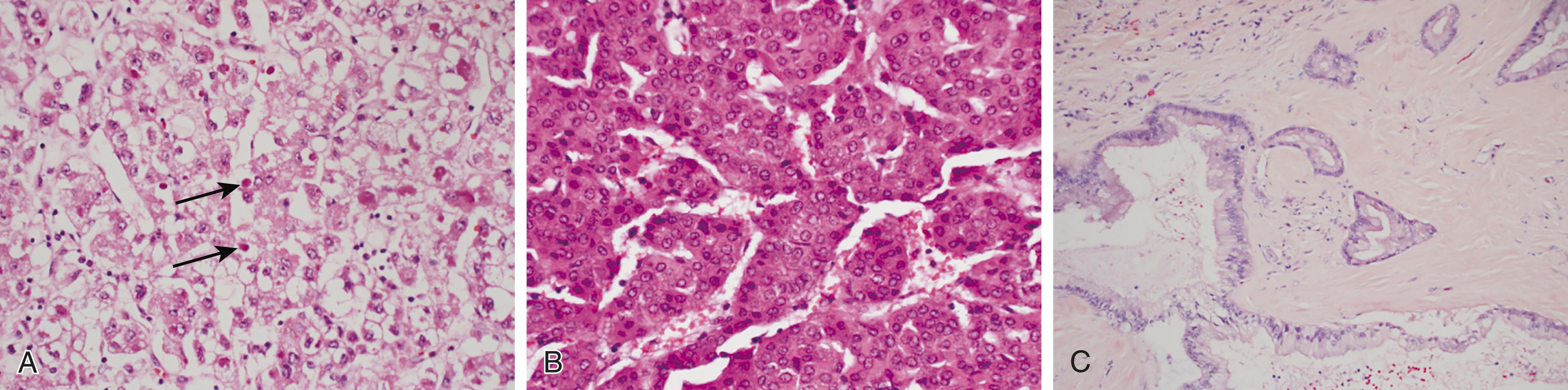 FIGURE 181-3, Histology of hepatocellular carcinoma and cholangiocarcinoma.