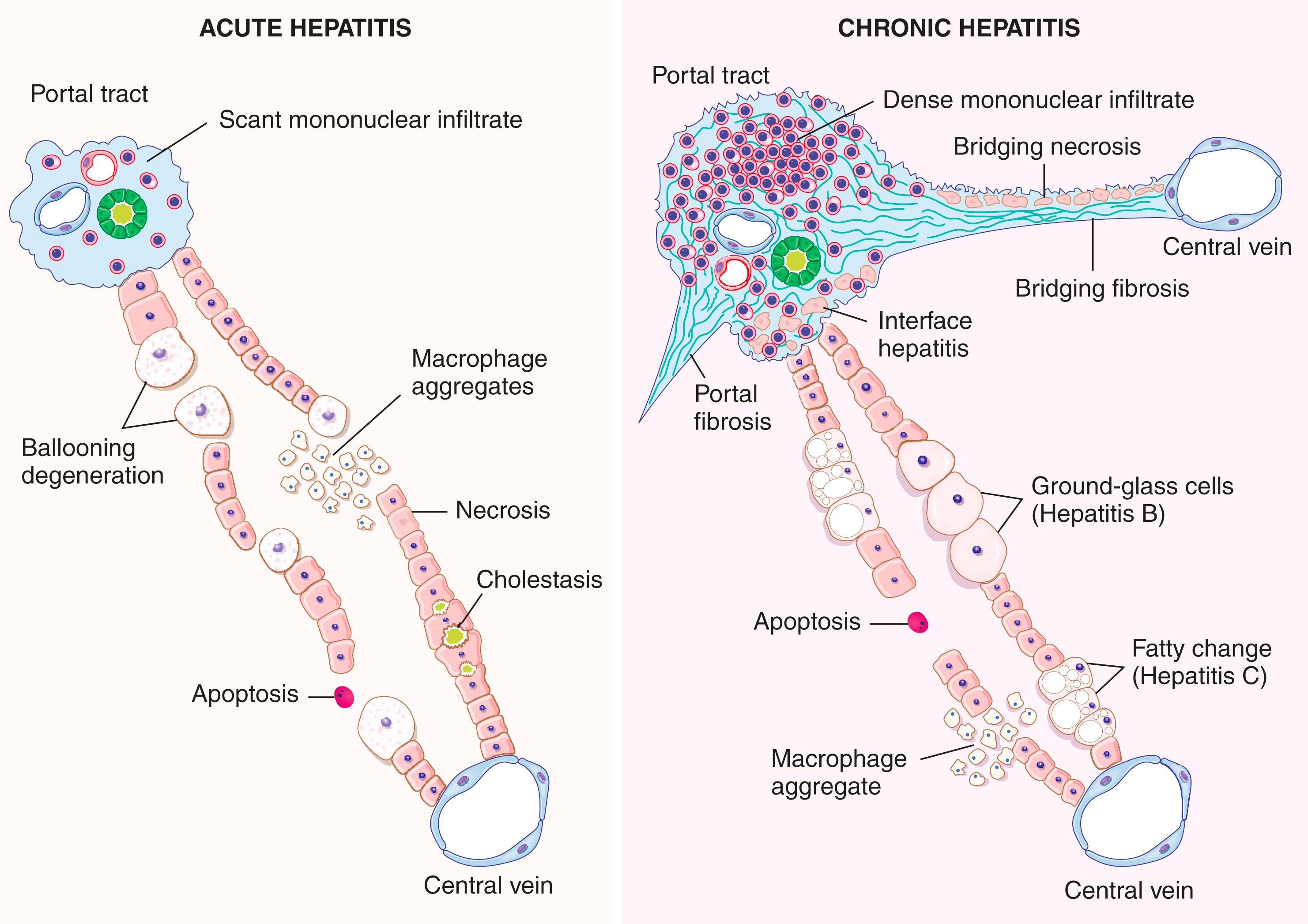 FIG. 14.13, Morphologic features of acute and chronic hepatitis. There is very little portal mononuclear infiltration in acute hepatitis (or sometimes none at all), while in chronic hepatitis portal infiltrates are dense and prominent—the defining feature of chronic hepatitis. Bridging necrosis and fibrosis are shown only for chronic hepatitis, but bridging necrosis may also occur in more severe acute hepatitis. Ductular reactions in chronic hepatitis are minimal in early stages of scarring but become extensive in late-stage disease.