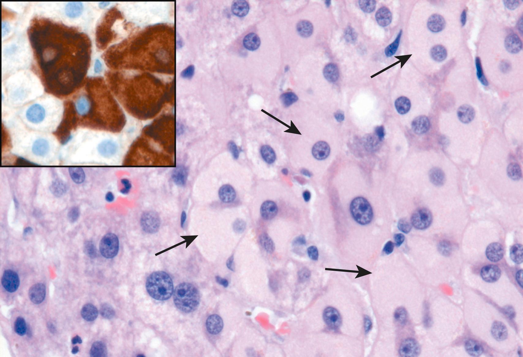 FIG. 14.14, Ground-glass hepatocytes (arrows) in chronic hepatitis B, caused by accumulation of hepatitis B surface antigen. Hematoxylin-eosin staining shows the presence of abundant, finely granular pink cytoplasmic inclusions; immunostaining (inset) with a specific antibody confirms the presence of surface antigen (brown).