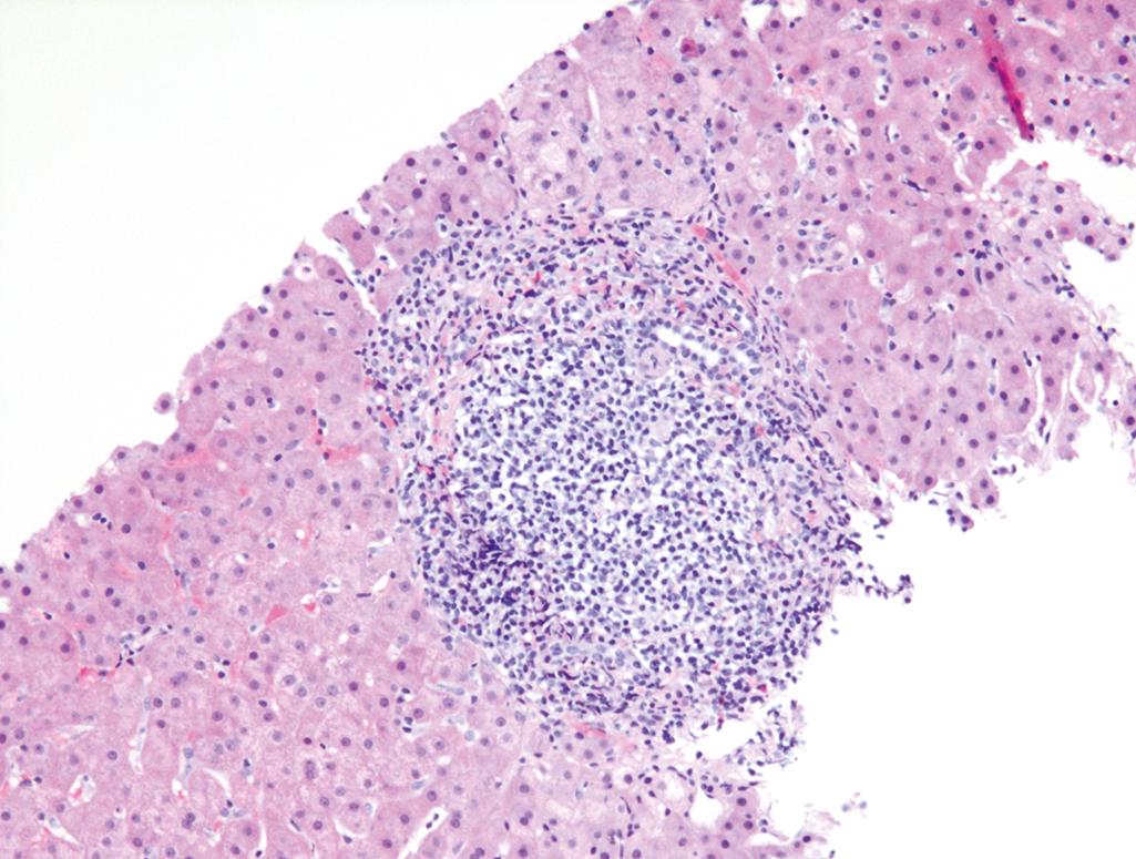 FIG. 14.15, Chronic viral hepatitis due to HCV, showing characteristic portal tract expansion by a dense lymphoid infiltrate.