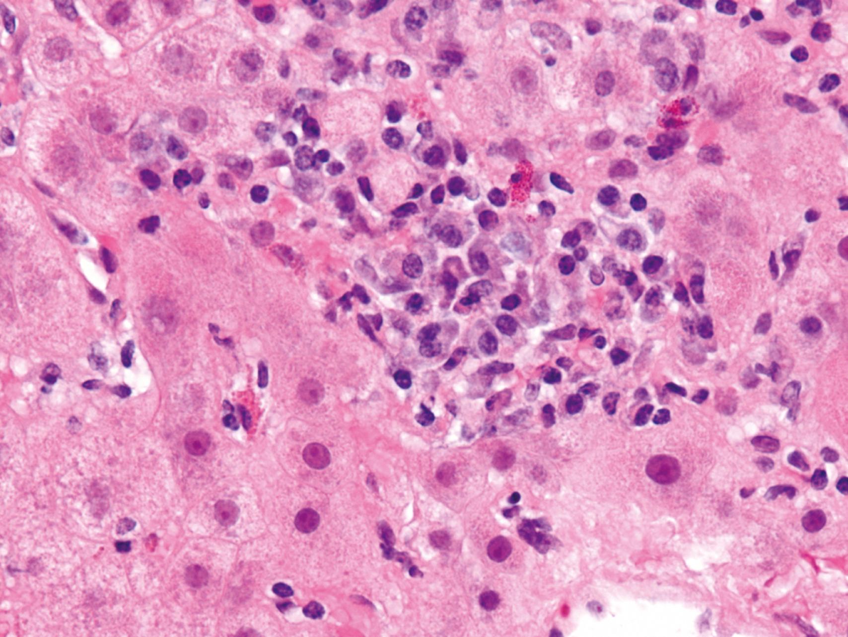 eFIG. 14.1, Autoimmune hepatitis. A focus of lobular hepatitis with prominent plasma cells typical for this disease is shown.