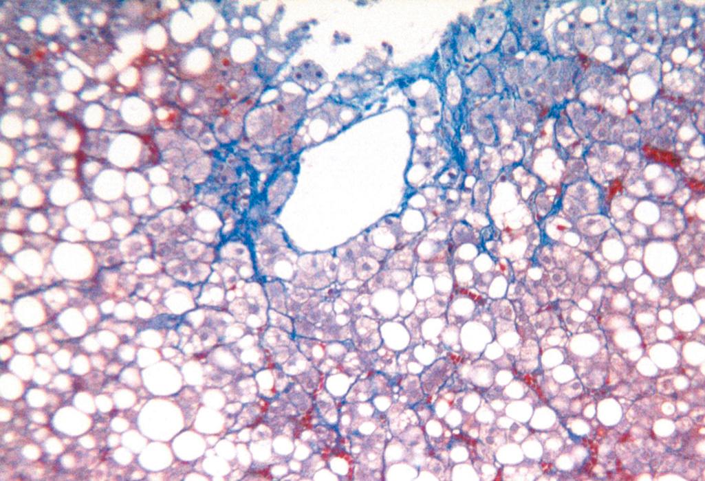 FIG. 14.16, Fatty liver disease associated with chronic alcohol use. A mix of small and large fat droplets (seen as clear vacuoles) is prominent. Some fibrosis (stained blue) is present in a characteristic perisinusoidal “chicken wire fence” pattern (Masson trichrome stain).