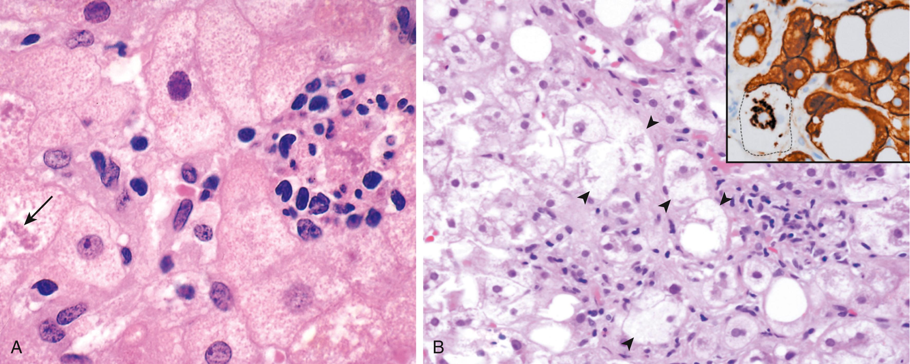 FIG. 14.17, Hepatocyte injury in fatty liver disease associated with chronic alcohol use. (A) Clustered inflammatory cells marking the site of a necrotic hepatocyte. A Mallory hyaline body is present in another hepatocyte (arrow). (B) “Ballooned” hepatocytes (arrowheads) associated with clusters of inflammatory cells. The inset stained for keratins 8 and 18 (brown) shows a ballooned cell (dotted line) in which keratins have been ubiquitinated and have collapsed into an immunoreactive Mallory hyaline body, leaving the cytoplasm “empty.”