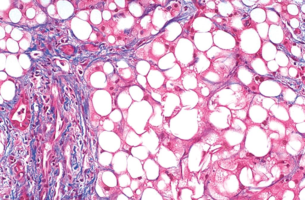 eFIG. 14.2, Nonalcoholic steatohepatitis. This liver with trichrome stain shows blue-staining collagenous fibrosis within the liver parenchyma. Virtually every hepatocyte is filled with a clear lipid droplet.