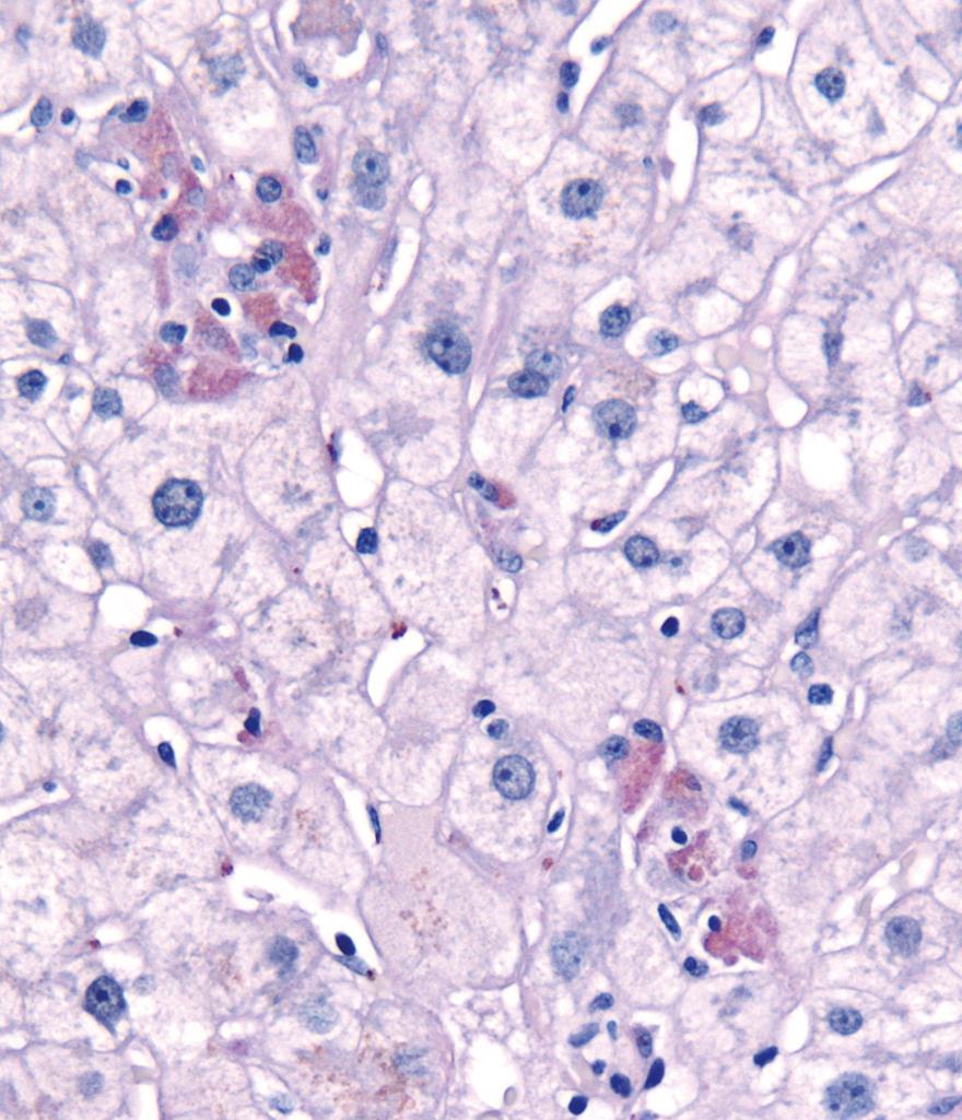 FIG. 14.2, Hepatocyte necrosis. This PAS-D–stained biopsy shows clusters of pigmented hepatocytes with eosinophilic cytoplasm indicative of hepatocytes undergoing necrosis. PAS-D, Periodic acid–Schiff stain after diastase digestion.