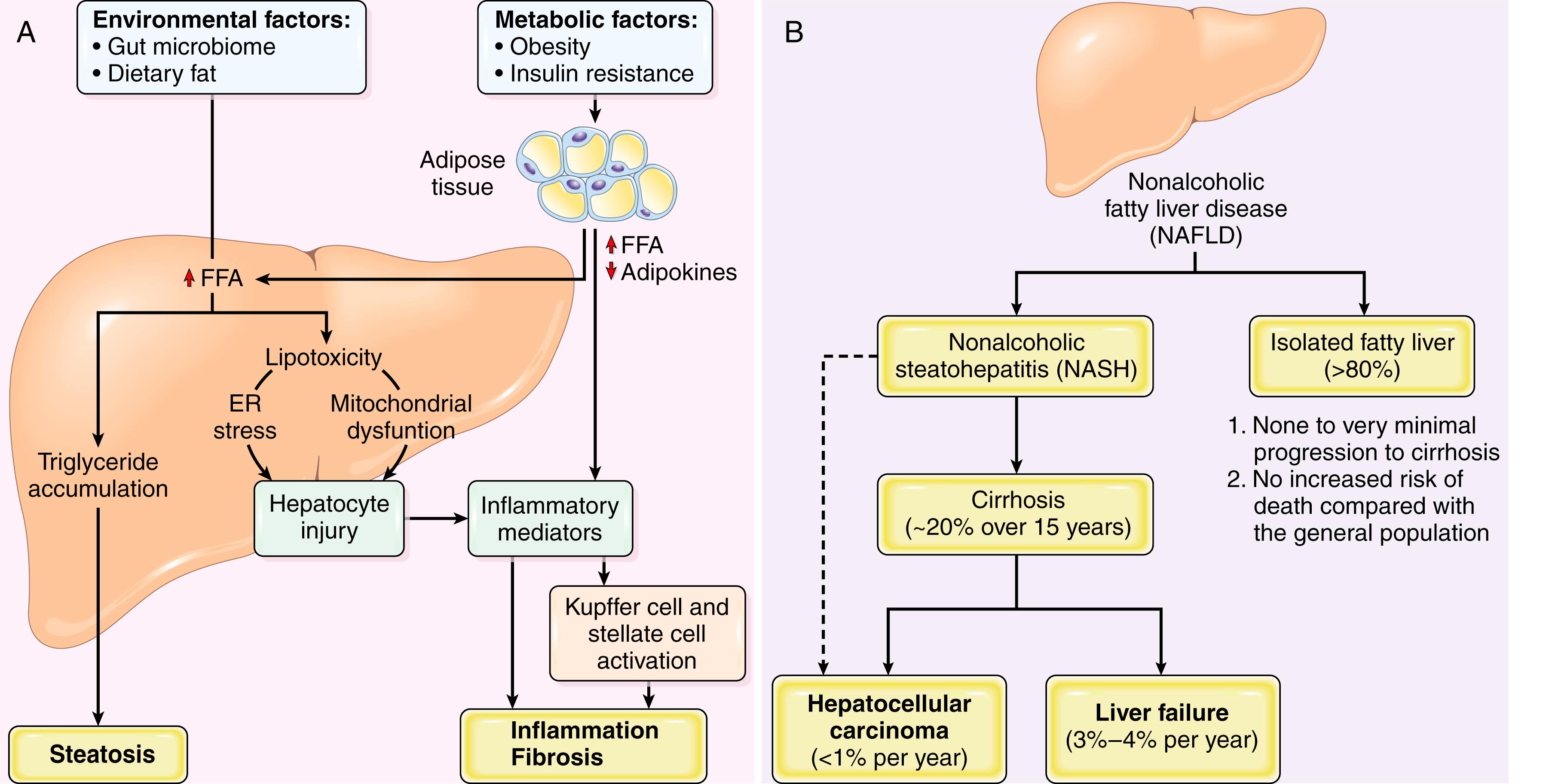 FIG. 14.19, (A) Pathogenesis of nonalcoholic fatty liver disease (NAFLD). (B) Natural history of NAFLD. Isolated fatty liver disease shows minimal risk for progression to cirrhosis or increased mortality, while nonalcoholic steatohepatitis shows increased overall mortality as well as increased risk for cirrhosis and hepatocellular carcinoma. ER , Endoplasmic reticulum; FFA , free fatty acid.