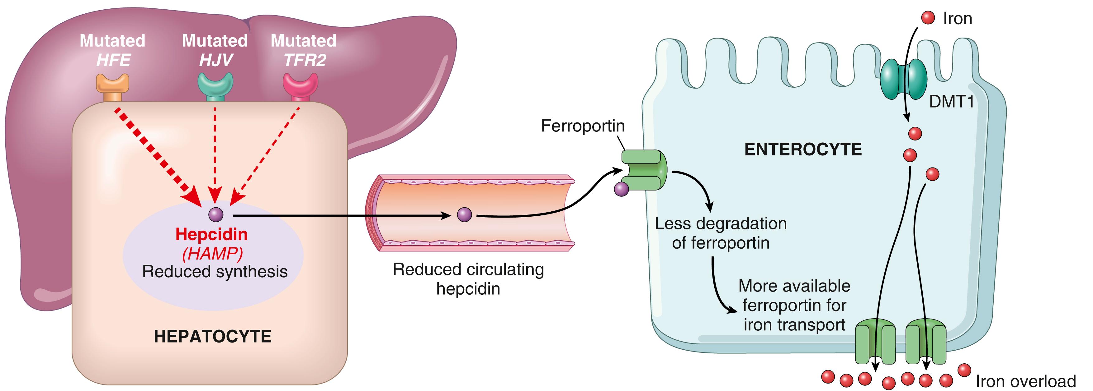 FIG. 14.20, Pathogenesis of hemochromatosis. Following iron uptake into enterocytes mediated by divalent metal transporter 1 (DMT1), iron secretion into the plasma depends on a second transporter, ferroportin. Hepcidin negatively regulates this process by binding ferroportin and stimulating its proteolytic degradation. Hepcidin production is regulated by an 