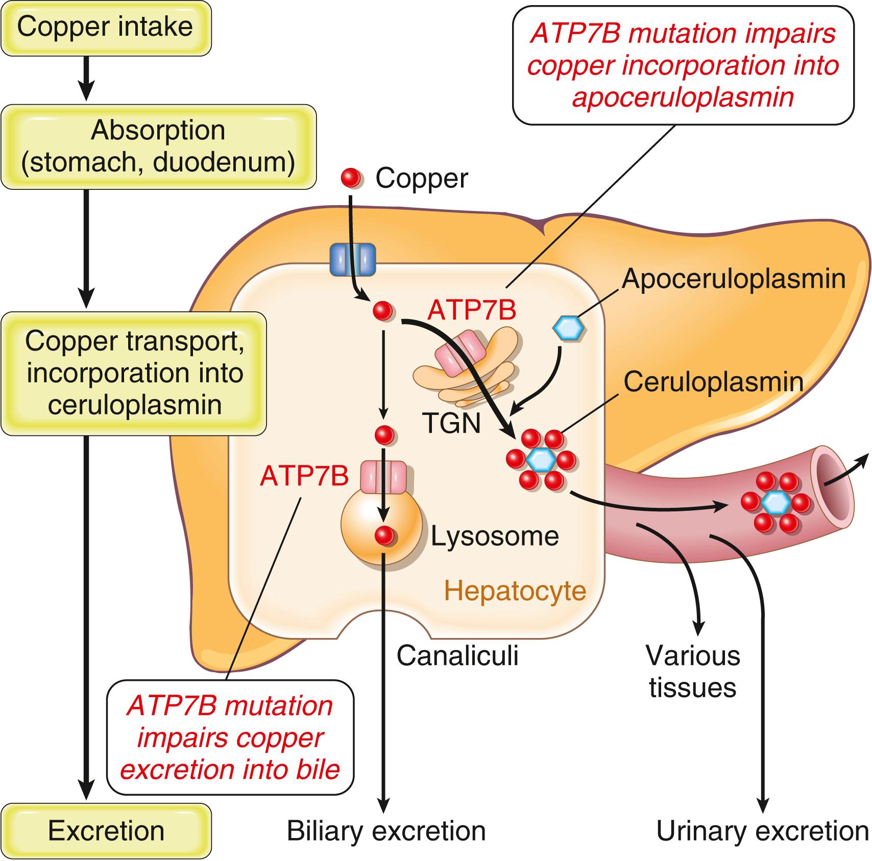 FIG. 14.22, Copper metabolism and consequences of mutation affecting ATP7B, the copper transporting hepatic protein. In Wilson disease failure of copper transport out of the hepatocytes into the blood in the form of ceruloplasmin and into bile cause accumulation of copper in the liver with resultant hepatocyte injury and eventual release of copper into the bloodstream with toxic injury to other tissues. TGN, Trans-Golgi network.