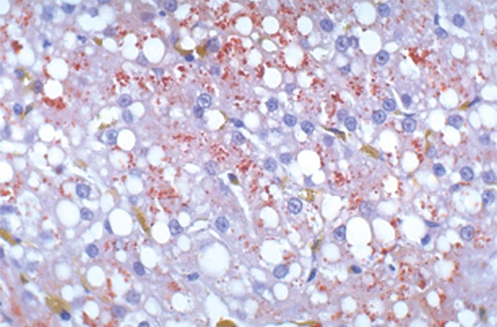 eFIG. 14.3, Wilson disease. The red-brown granular material seen here with a copper stain is excessive lysosomal copper owing to mutation of the ATP7B gene encoding a copper-transporting ATPase.