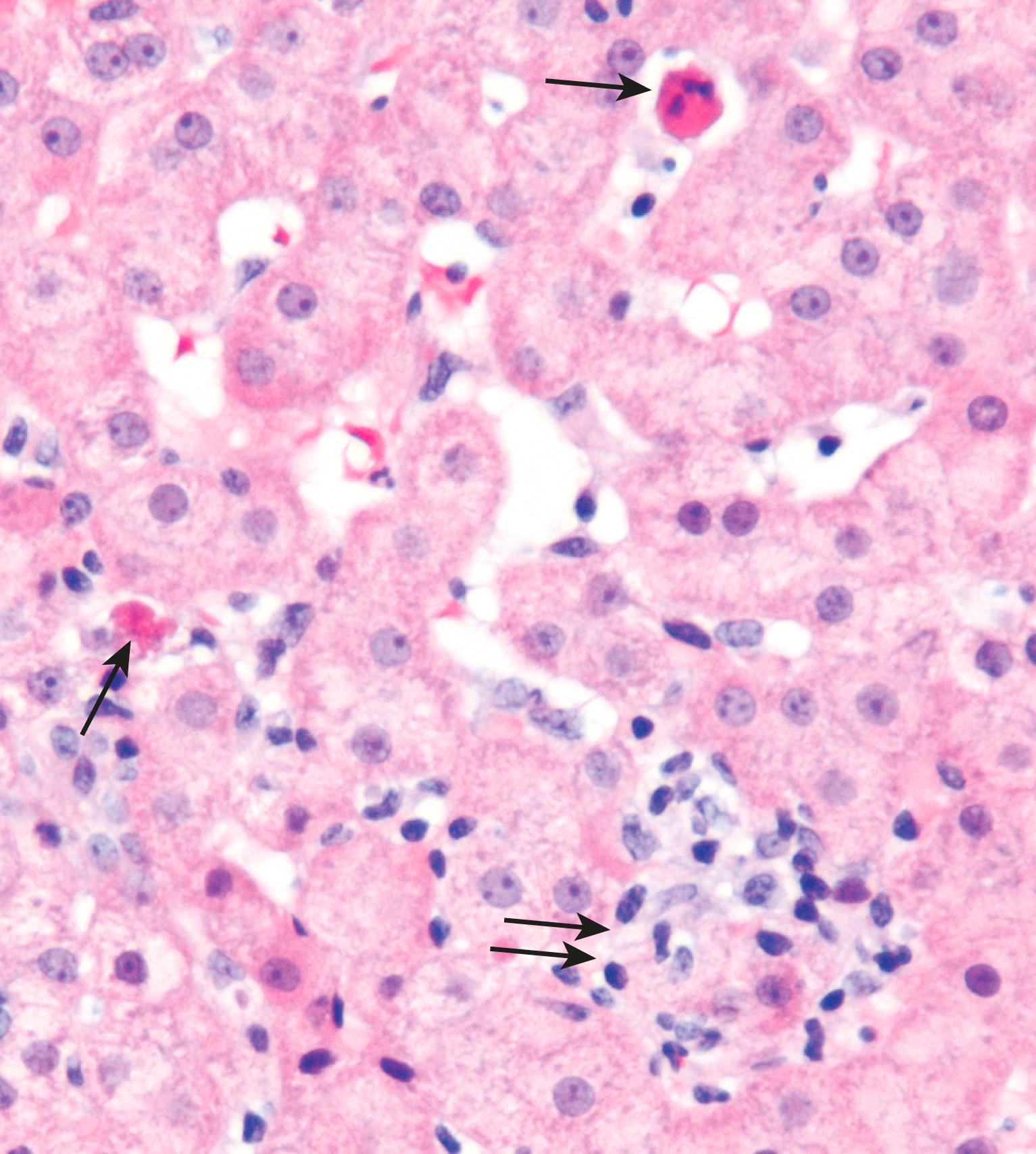 FIG. 14.3, Hepatocyte apoptosis. This biopsy from a patient with hepatitis due to chronic hepatitis C shows scattered apoptotic hepatocytes (“acidophil bodies”; single arrows ) and a patchy inflammatory infiltrate (double arrows).