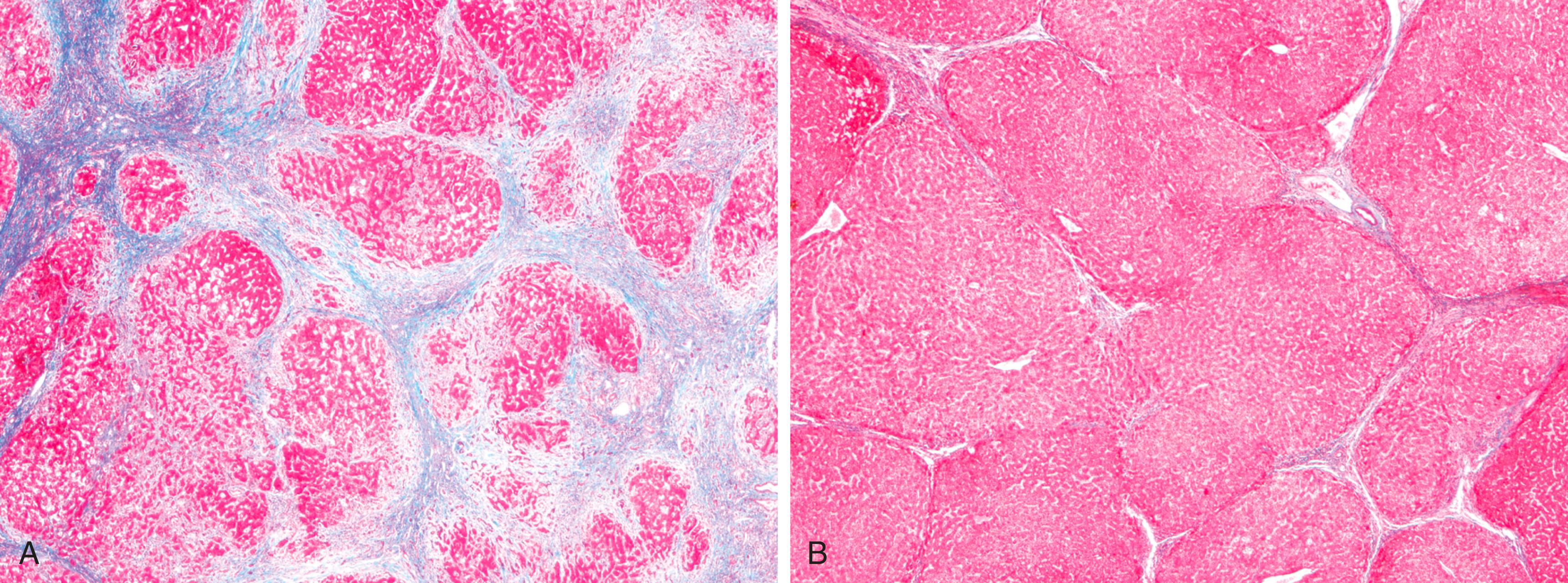 FIG. 14.6, Alcohol-related cirrhosis in a patient who was actively drinking (A) and following long-term abstinence (B). (A) Thick bands of collagen separate rounded cirrhotic nodules. (B) After 1 year of abstinence, most scars are gone (Masson trichrome stain).