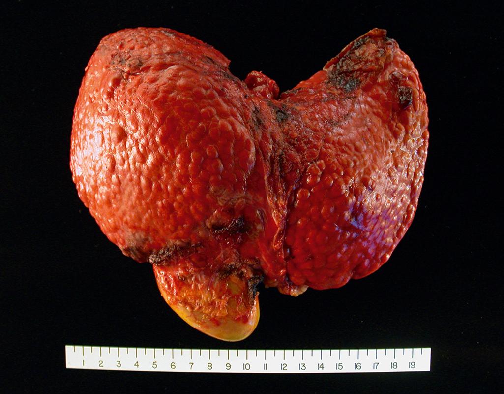 FIG. 14.5, Cirrhosis resulting from chronic viral hepatitis. Note the broad scars separating bulging regenerative nodules over the liver surface.