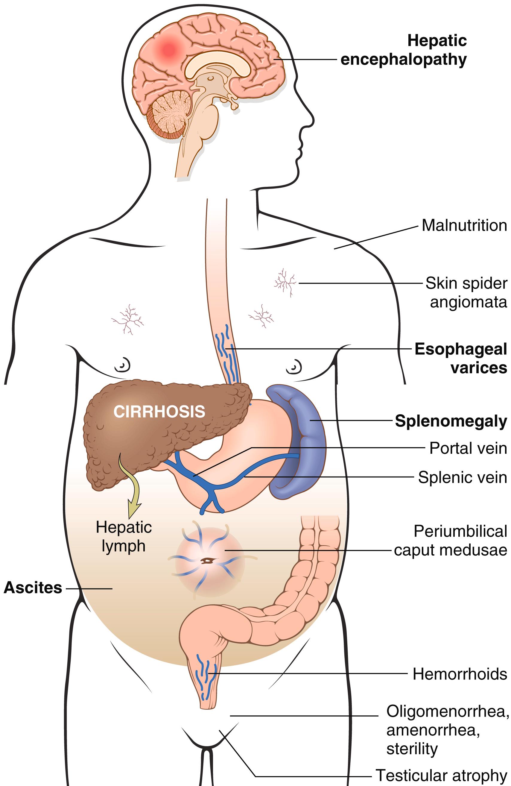 FIG. 14.7, Major clinical consequences of portal hypertension in the setting of cirrhosis.