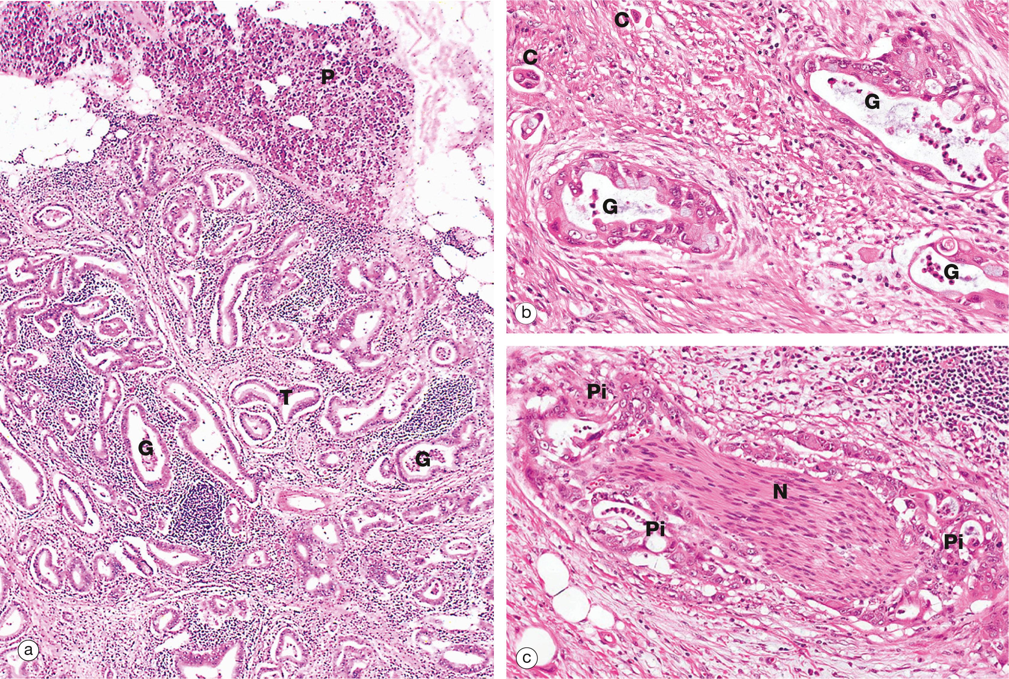 Fig. 15.16, Adenocarcinoma of pancreas