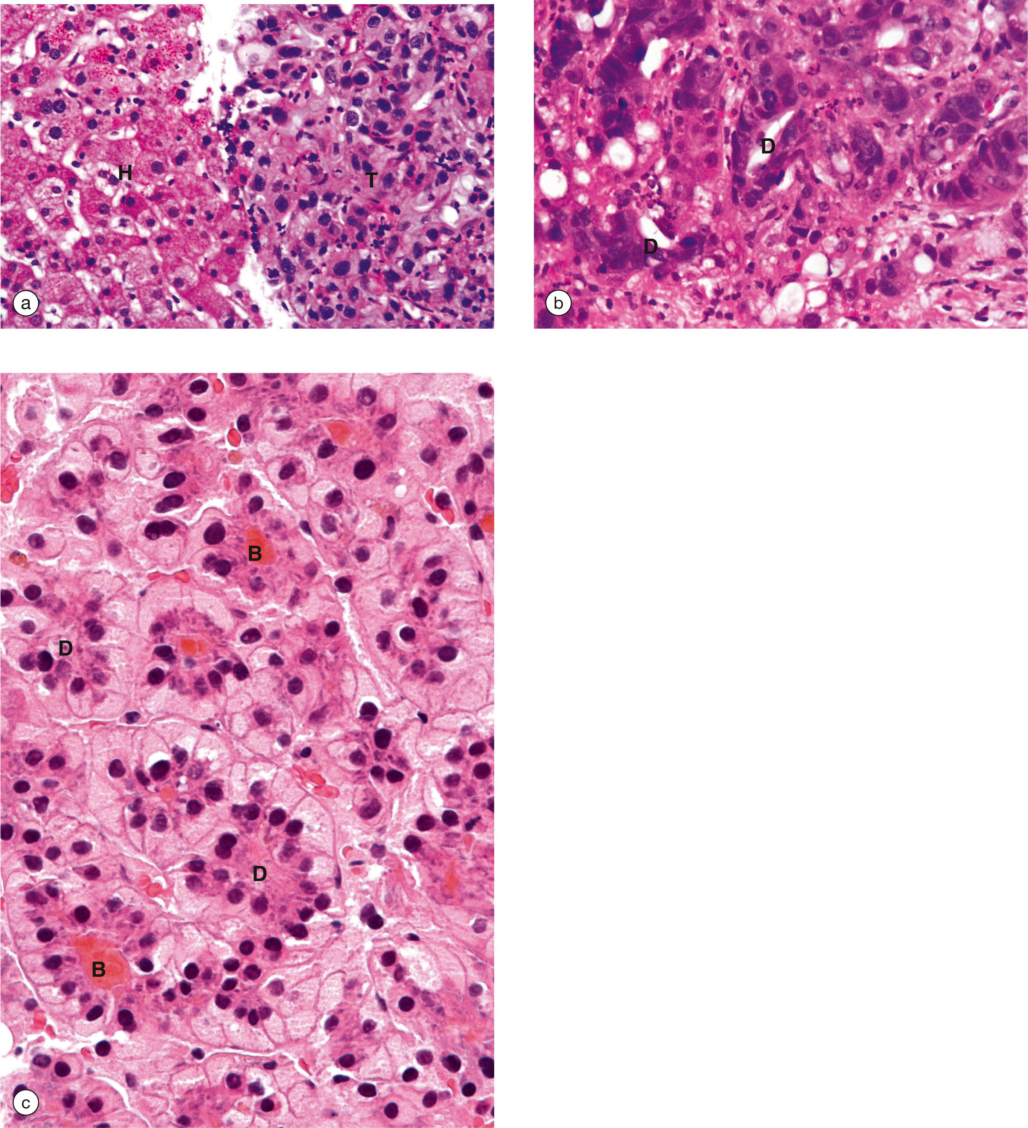 E-Fig. 15.3, Hepatocellular carcinoma