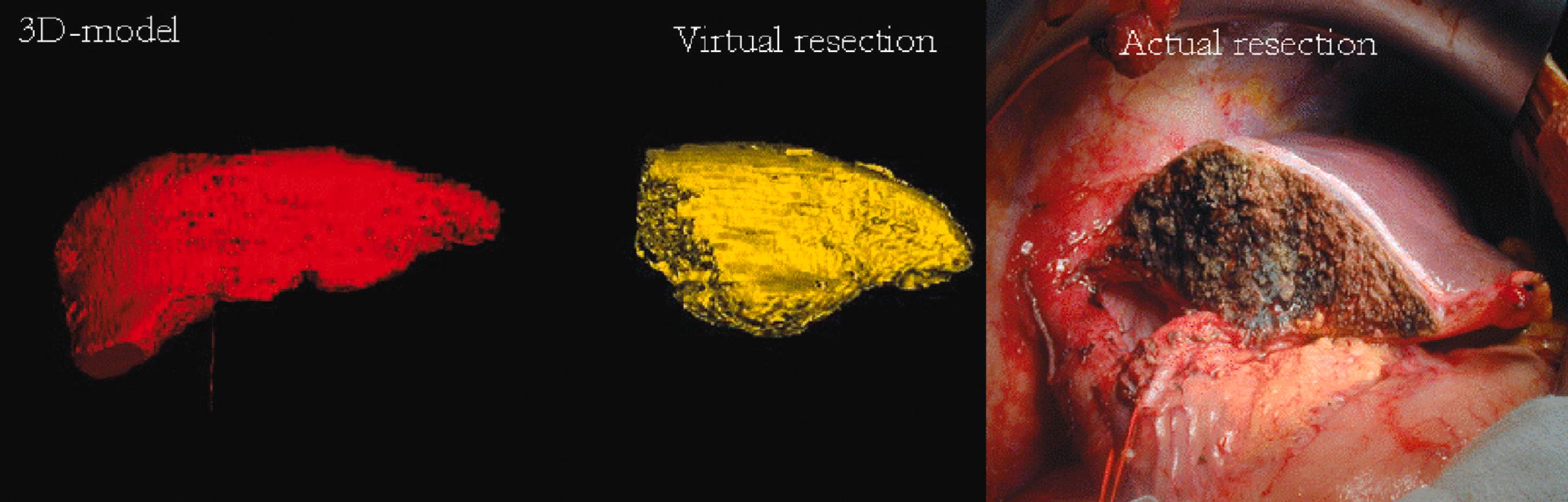 Figure 2.1, Three-dimensional (3D) reconstruction of the liver preoperatively (red) showing tumours. Computer prediction of residual liver volume based on virtual hepatectomy of 3D model (yellow) and actual photograph of resection showing residual liver segments.