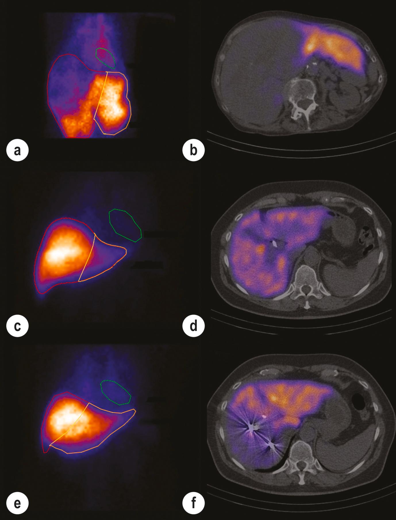 Figure 2.5, Hepatobiliary scintigraphy before major liver surgery in a patient with a large hepatocellular carcinoma of the right liver (a, b) and a patient with a Klatskin type IIIa tumour before (c, d) and 3 weeks after portal vein embolisation (PVE) (e, f) . Panels a and b show a large afunctional right-sided hepatic mass with sufficient future liver remnant function in segments 2–3. Panels c and d show relatively small liver segments 2–3 with insufficient future liver remnant function (1%/min/m 2 ). Volume and function of segments 2–3 increased significantly after PVE (panels e and f) with sufficient future liver remnant function (2.7%/min/m 2 ) for safe resection (extended right hemihepatectomy).