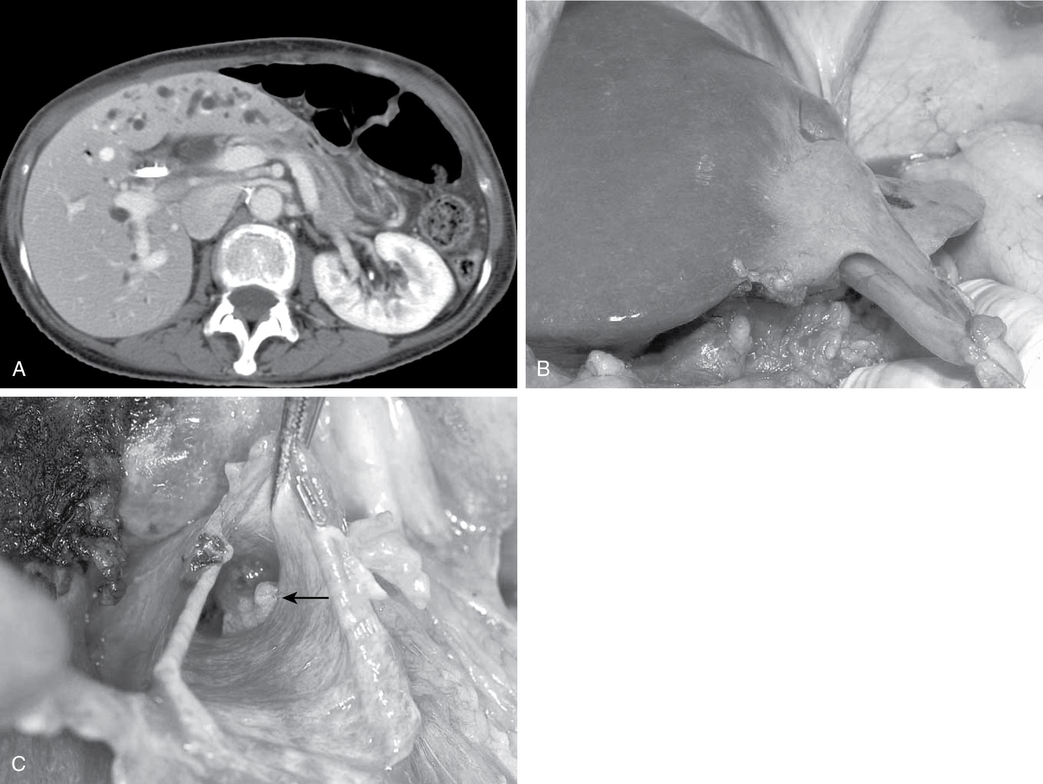 FIGURE 6.5, Hepatic atrophy.