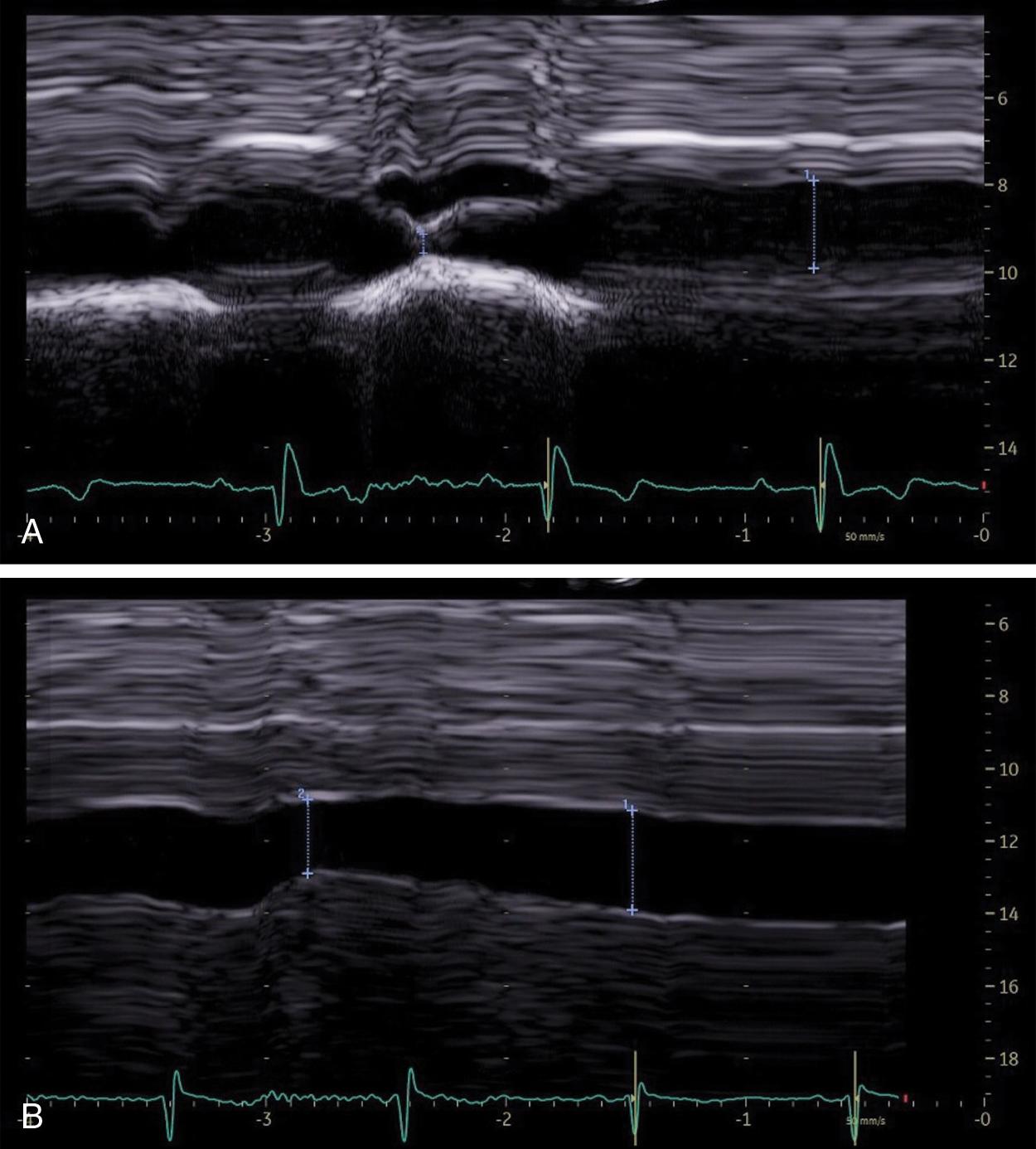 Fig. 9.1, (A) M-mode image of the inferior vena cava (IVC) with respiration in an 81-year-old female with chest pain. The IVC changes from 2.0 to 0.4 cm during respiration. With a diameter ≤2.1 cm that collapses >50% with a breath, this suggests the patient has a normal right atrial pressure (3 mmHg; range, 0–5 mmHg). (B) M-mode image of the IVC in a 68-year-old male with a pericardial effusion. The IVC has an abnormal response to respiration changing from 2.8 to 2.0 cm. With an IVC diameter >2.1 cm that collapses <50% with a breath this suggests the patient has a high right atrial pressure (15 mmHg; range, 10–20 mmHg).