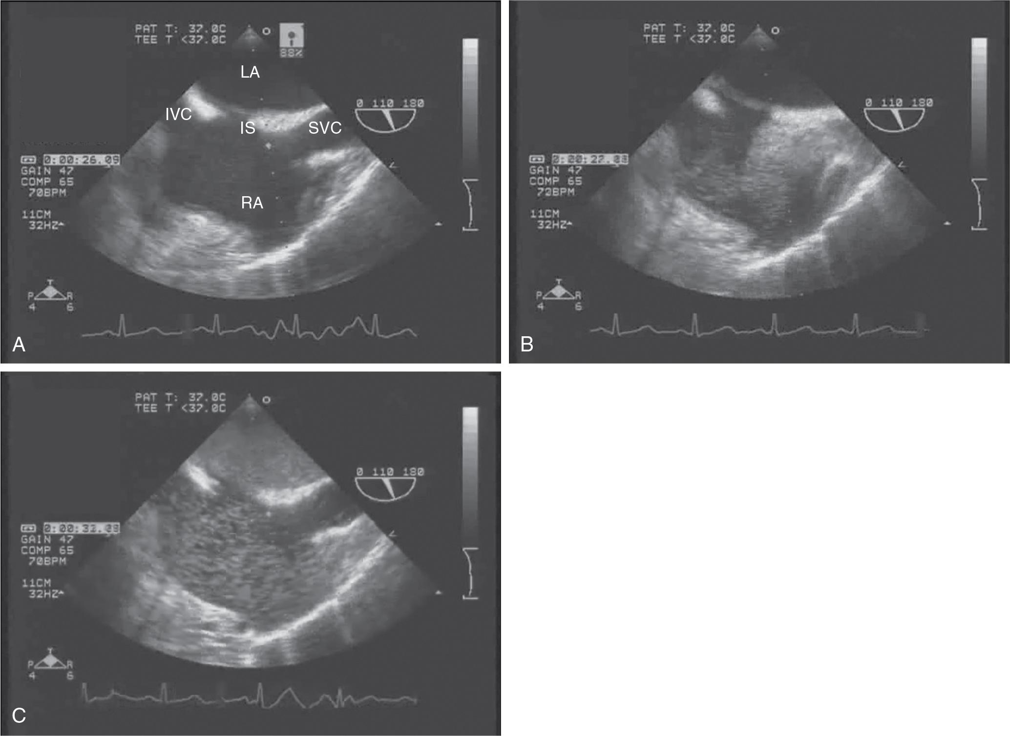 FIGURE 106.1, Intraoperative transesophageal echocardiography (TEE) in a patient with hepatopulmonary syndrome and intrapulmonary shunting demonstrates a positive bubble study.