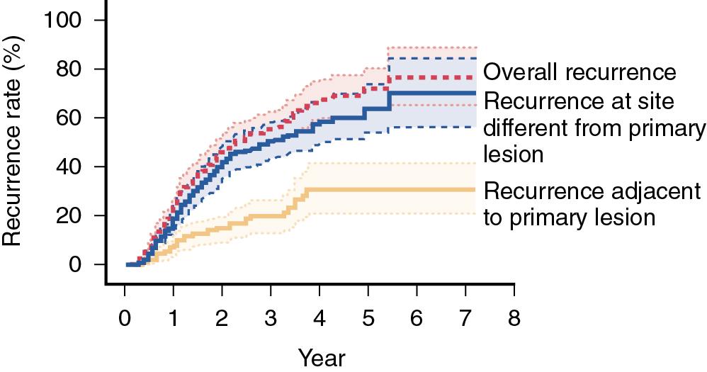 FIGURE 108A.1, Recurrence of hepatocellular carcinoma after ablation most often occurs at a site distant from the primary tumor, suggesting a second tumor was present at the time of treatment that was too small to be detected.