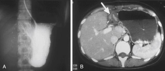 FIGURE 48-1, Adhesion of the gastric wall to the cut surface of liver after left lateral segmentectomy in pediatric living related liver transplantation. A, Gastric stasis as a result of outlet obstruction. B, Computed tomography shows the hairpin curve of the gastric outlet at the adhesion site (arrow) .