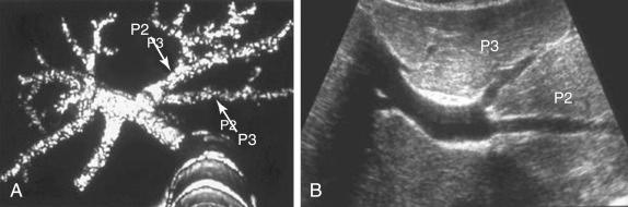 FIGURE 48-3, Variation of the portal vein to the left lateral segment. The portal vein to segment III (P3) and segment II (P2) is branching separately. If this lateral segment is taken as the graft, the graft will have two orifices in the portal stump. A, Three-dimensional computed tomography. B, Ultrasonography.