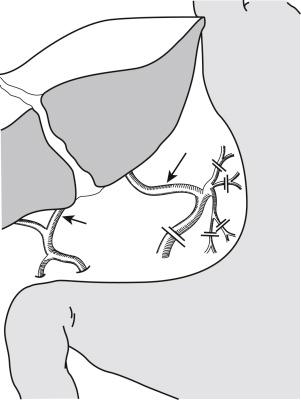 FIGURE 48-4, Aberrant hepatic artery supplying the left lateral segment (long arrow) originating from the left gastric artery. If the main left hepatic artery (small arrow) is small, this aberrant artery may be large. For reconstruction in the recipient, this artery should be kept long by transecting as indicated by the double line .