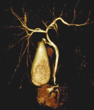 FIGURE 48-5, Three dimensional reconstruction of drip infusion cholangiography–computed tomography of the donor. The image can be rotated on the monitor, and the branching can be easily identified.