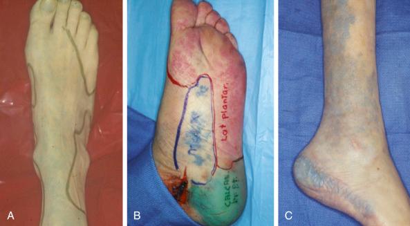 Figure 48.2, The angiosomes of the foot and ankle.