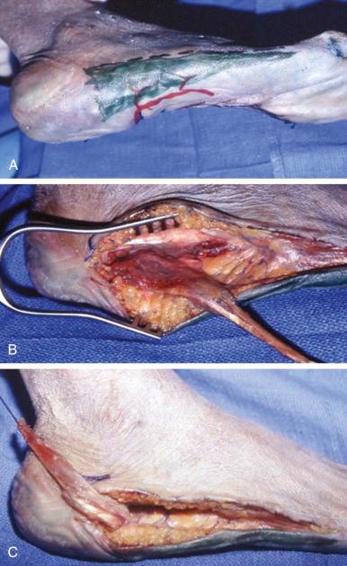 Figure 48.5, Abductor digiti mini technique (cadaver dissection).