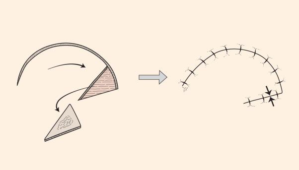 Fig. 2.5.6, Standard rotation flap is a pivotal flap with a semicircular configuration that can be utilized to cover a triangular defect.