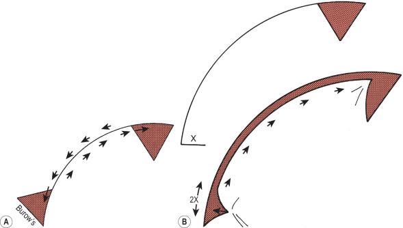 Fig. 2.5.7, Variations of the rotational flap, including (A) excision of a Burow's triangle to correct for length discrepancy between the margin of the flap and the margin of the surrounding skin, and (B) a back-cut to decrease tension along the suture line by altering the location of the pivot point.